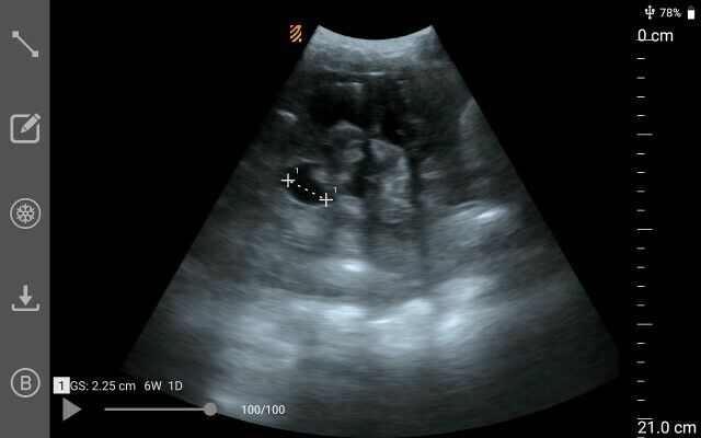 MX5 Go Portable Ultrasound The World’S First App-Based Swine Ultrasound DIAGNOSTIC ULTRASOUND MACHINES FOR SALE