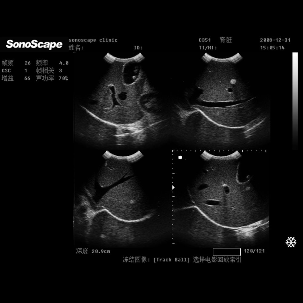 NEW! SonoScape A6 Portable Ultrasound Scanner Machine System + Laptop Style DIAGNOSTIC ULTRASOUND MACHINES FOR SALE