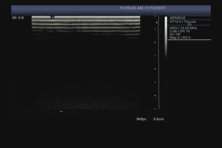Siemens VF13-5 Ultrasound Transducer Probe DIAGNOSTIC ULTRASOUND MACHINES FOR SALE