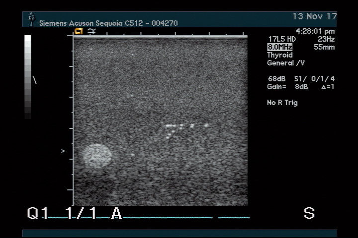 Acuson 17L5 HD Ultrasound Probe - New Lower Price! DIAGNOSTIC ULTRASOUND MACHINES FOR SALE