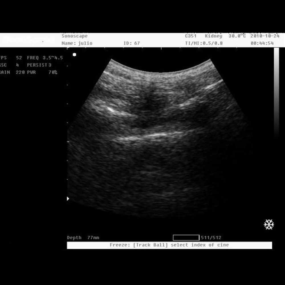 NEW! SonoScape A6 Portable Ultrasound Scanner Machine System + Laptop Style DIAGNOSTIC ULTRASOUND MACHINES FOR SALE