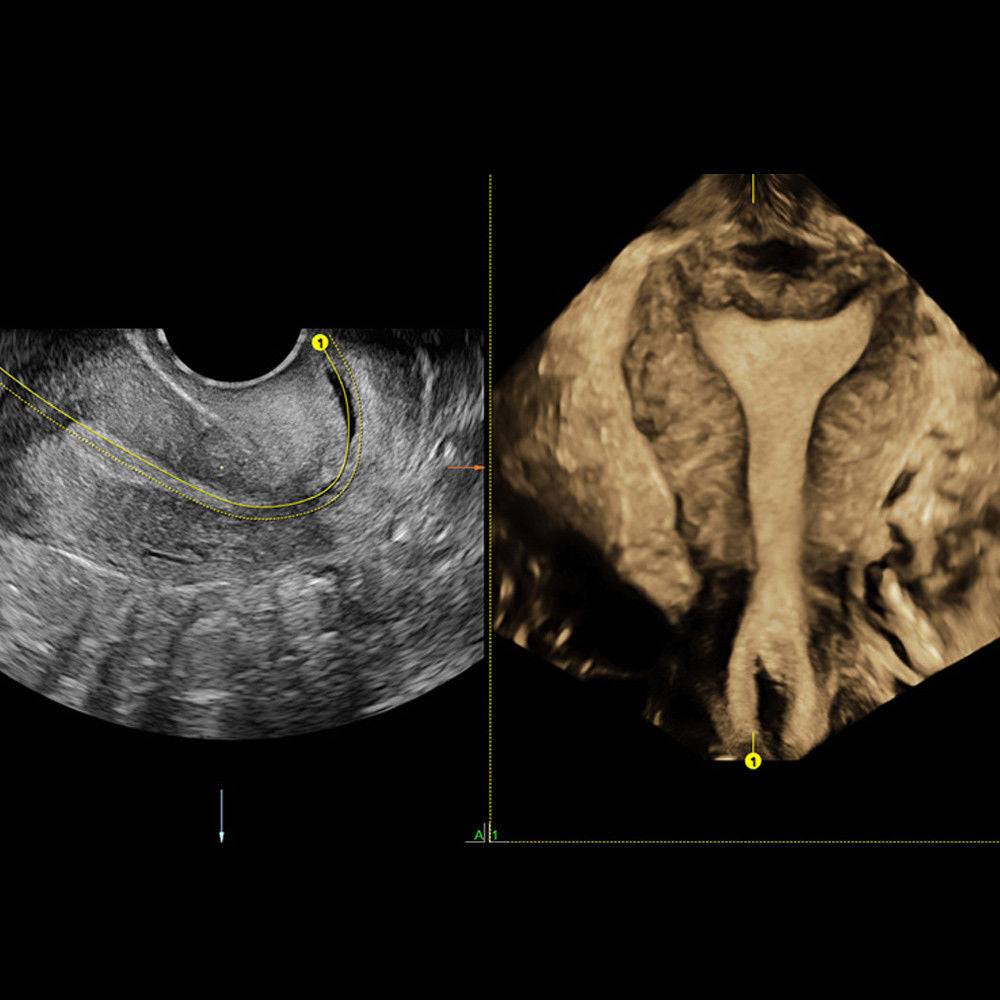 GE HD Live Ultrasound System 3D/4D - Voluson E6 Machine with RAB6-D Volumetric DIAGNOSTIC ULTRASOUND MACHINES FOR SALE