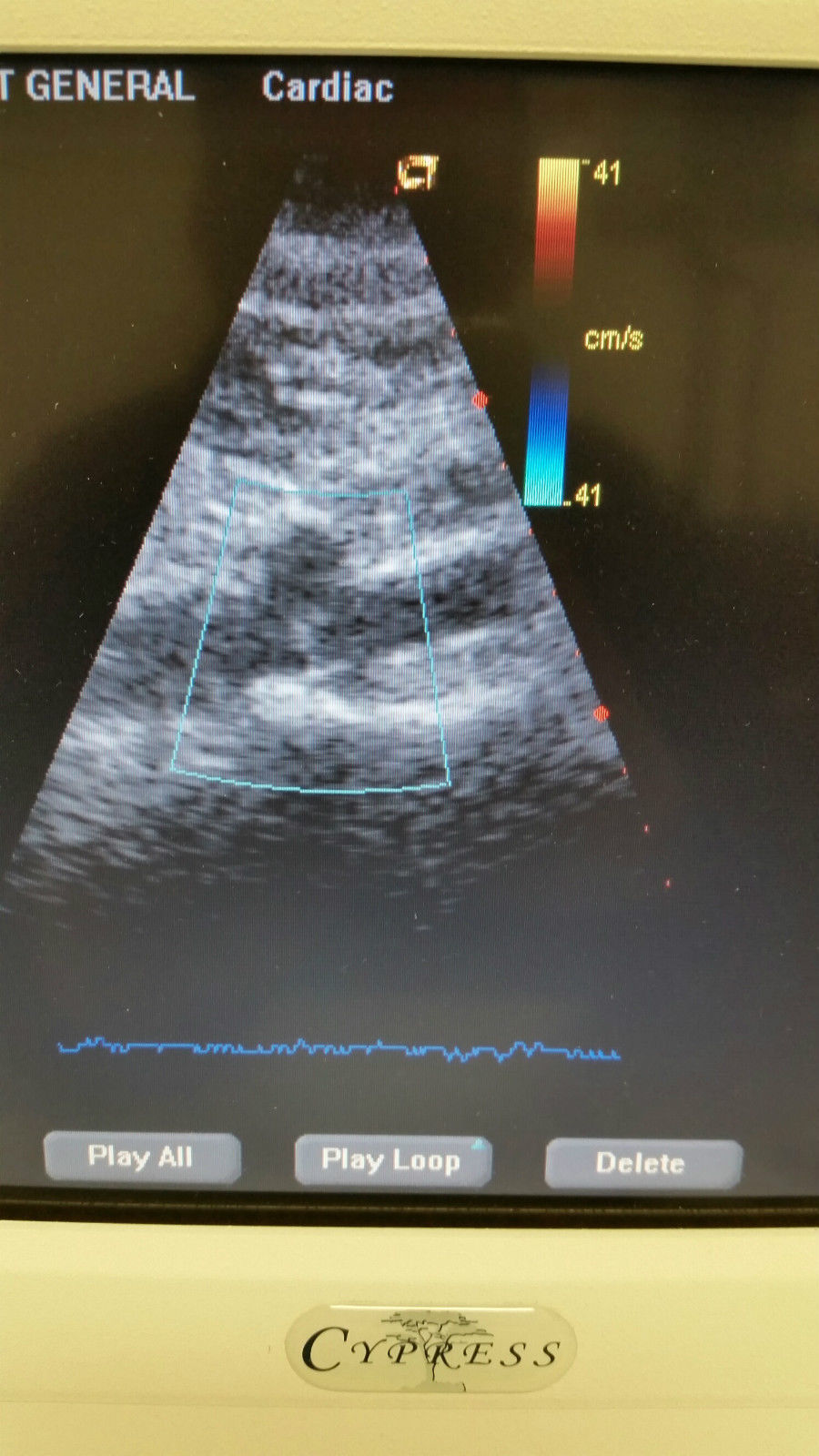 Acuson Cypress Cardiac Vascular Ultrasound Machine Rev 14 + CW, 3V2c, 7L3 Probe DIAGNOSTIC ULTRASOUND MACHINES FOR SALE