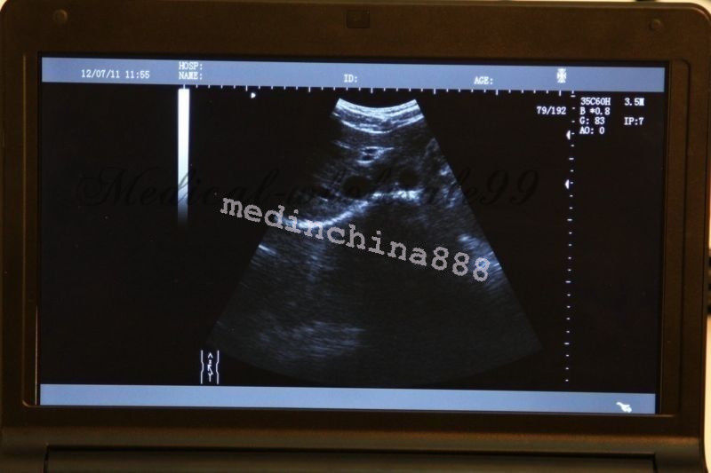 Portable LCD Digital 10.1-Inch Ultrasound Scanner + Convex+Transvaginal Probe CE DIAGNOSTIC ULTRASOUND MACHINES FOR SALE