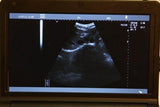 New 10.1" Digital Laptop Ultrasound Scanner For Men 7.5M Linear probe+Free *3D*