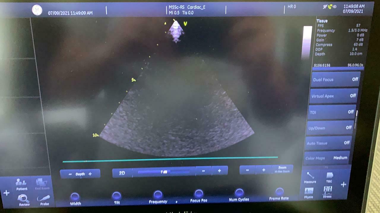 GE Vivid iQ Premium Portable Ultrasound System w/ M5Sc-Rs & 9L-Rs Probes DIAGNOSTIC ULTRASOUND MACHINES FOR SALE