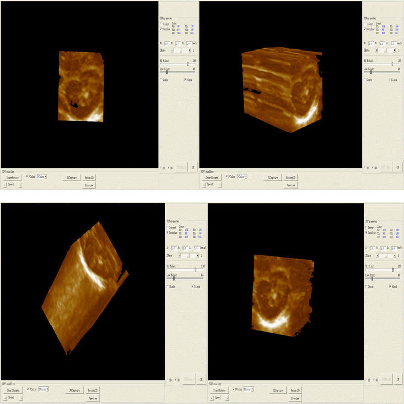 LCD Digital Ultrasound Scanner Scan with 6.5MHz Transvaginal Probe Medical Tool DIAGNOSTIC ULTRASOUND MACHINES FOR SALE